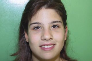 Ohren anlegen Bild nach OP 1